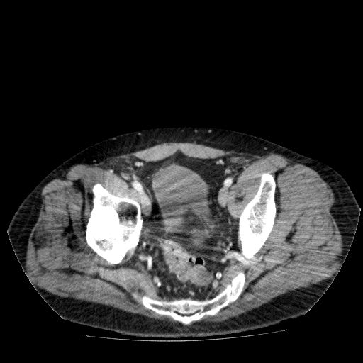 File:Acute cholecystitis and incidental left sided IVC (Radiopaedia 49352-54459 Axial C+ portal venous phase 135).jpg