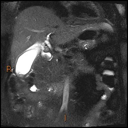File:Acute cholecystitis with gallbladder neck calculus (Radiopaedia 42795-45971 Coronal T2 Half-fourier-acquired single-shot turbo spin echo (HASTE) 7).jpg