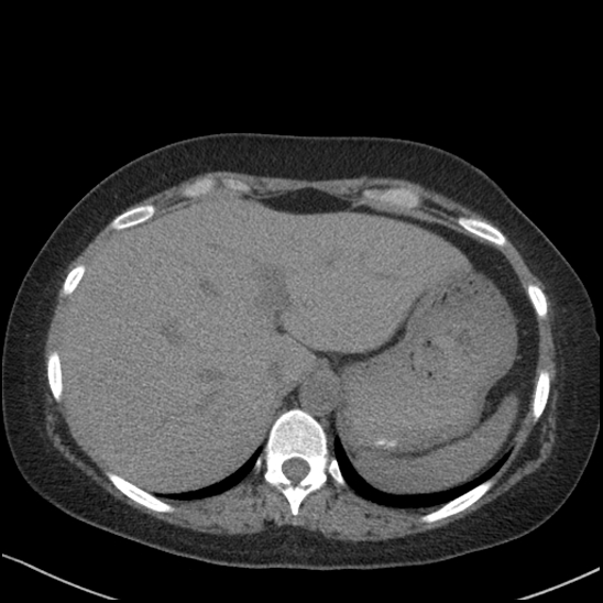 Acute colonic hemorrhage in ulcerative colitis (Radiopaedia 77415-89538 Axial non-contrast 23).jpg