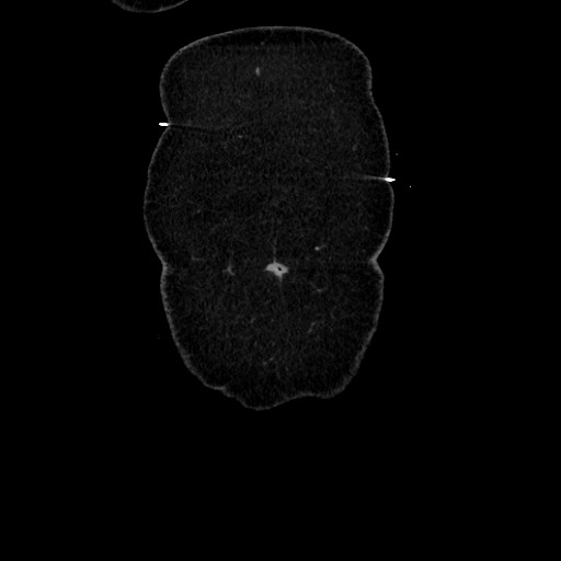 Acute diverticulitis - transverse colon (Radiopaedia 87063-103327 Coronal C+ portal venous phase 21).jpg