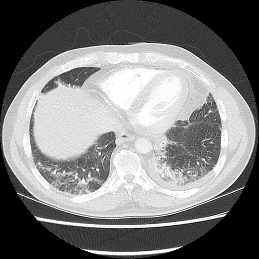 Acute epicardial fat necrosis (Radiopaedia 42327-45440 Axial lung window 42).jpg