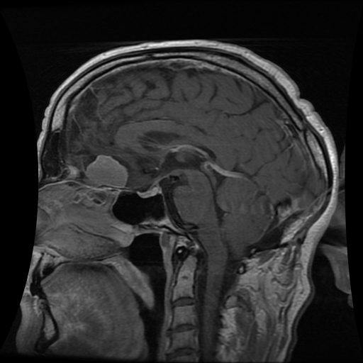 File:Acute hippocampal infarction (Radiopaedia 10610-11072 T1 C+ 1).jpg