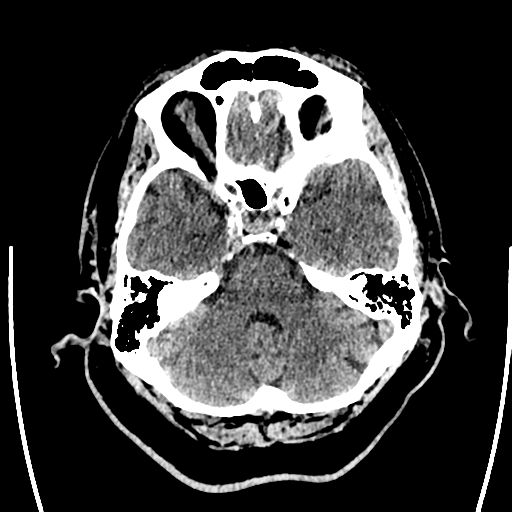 Acute left middle cerebral artery territory ischemic stroke (Radiopaedia 35688-37223 Axial non-contrast 19).png