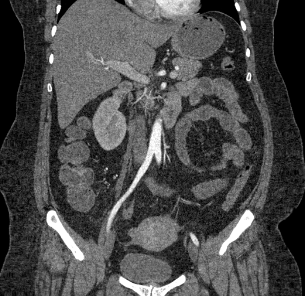 Acute mesenteric ischemia (Radiopaedia 80029-93316 Coronal C+ arterial phase 67).jpg