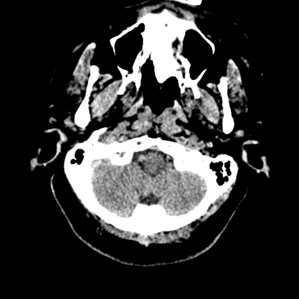 Acute middle cerebral artery territory infarct (Radiopaedia 52380-58283 Axial non-contrast 7).jpg