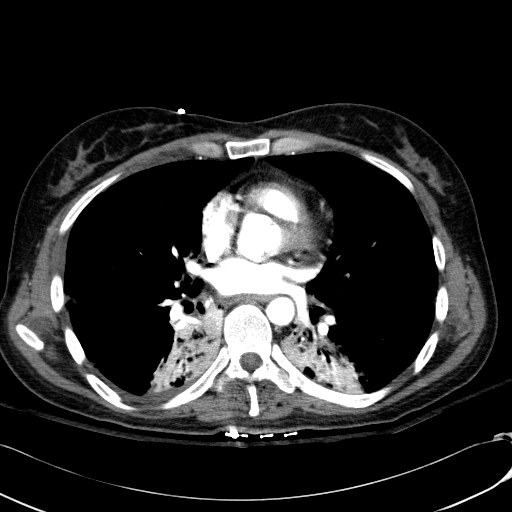 Acute myocardial infarction in CT (Radiopaedia 39947-42415 Axial C+ arterial phase 77).jpg