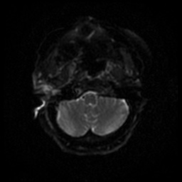 Acute otitis externa (Radiopaedia 57296-64236 Axial DWI 38).jpg