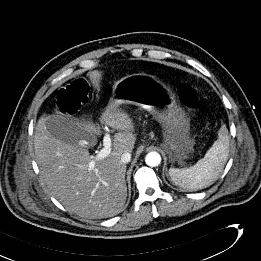 File:Acute pancreatic necrosis (Radiopaedia 13560-13486 Axial C+ portal venous phase 37).jpg