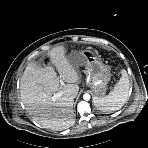 File:Acute pancreatic necrosis (Radiopaedia 13560-18502 Axial C+ portal venous phase 5).jpg