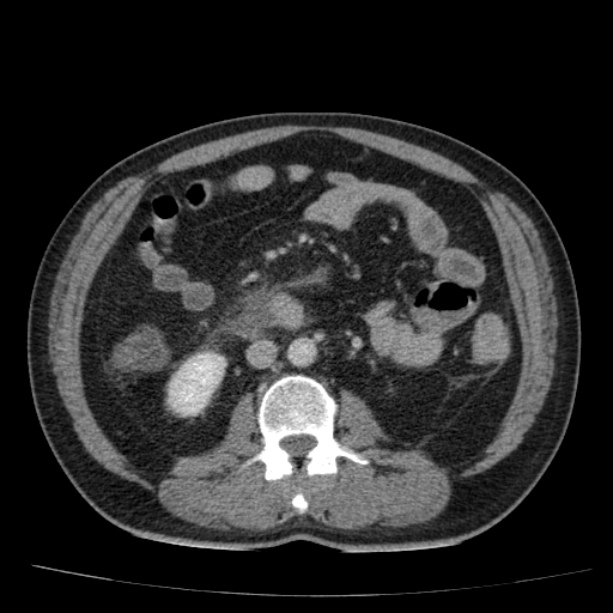 Acute pancreatitis (Radiopaedia 26663-26813 Axial C+ portal venous phase 45).jpg