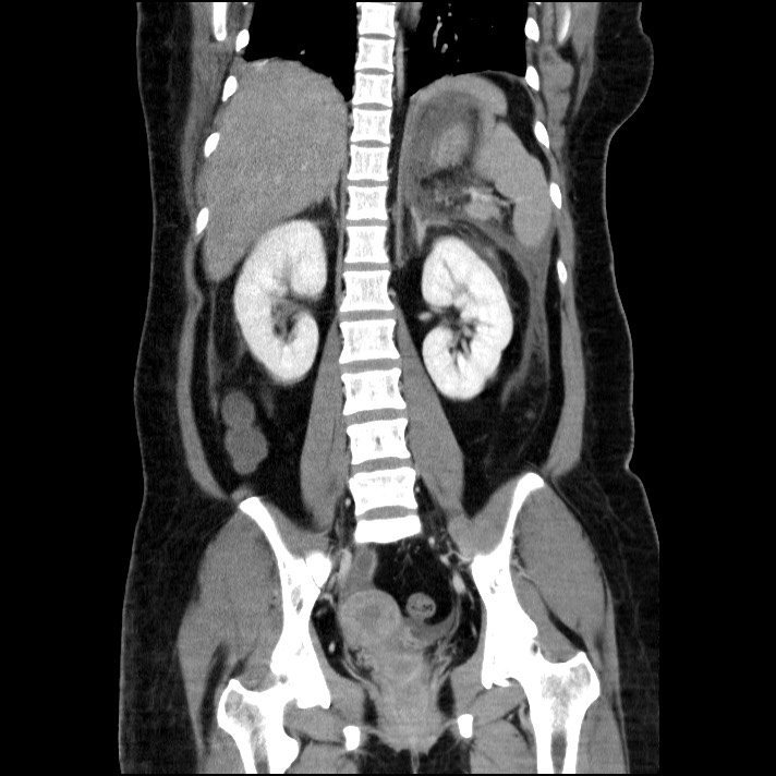 Acute pancreatitis (Radiopaedia 69236-79012 Coronal C+ portal venous phase 32).jpg