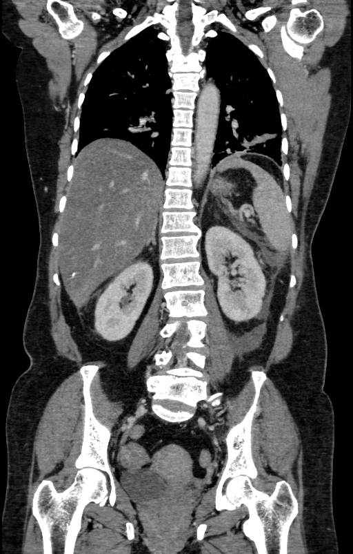 Acute pancreatitis (Radiopaedia 80007-93285 Coronal C+ portal venous phase 102).jpg