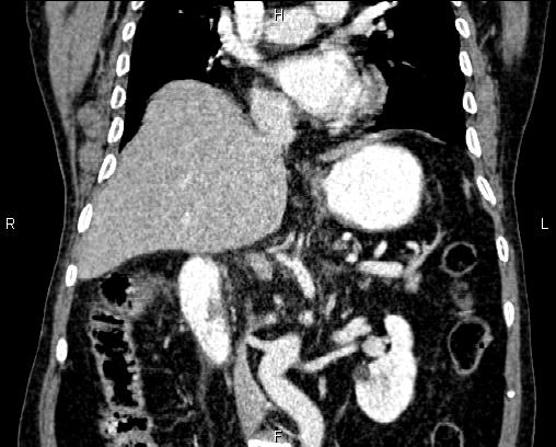 Acute pancreatitis (Radiopaedia 85146-100701 Coronal C+ portal venous phase 40).jpg