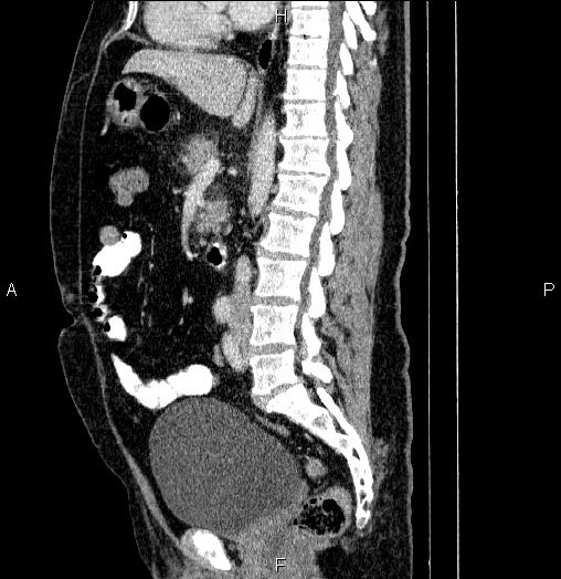 Acute pancreatitis (Radiopaedia 85390-101010 Sagittal C+ portal venous phase 50).jpg