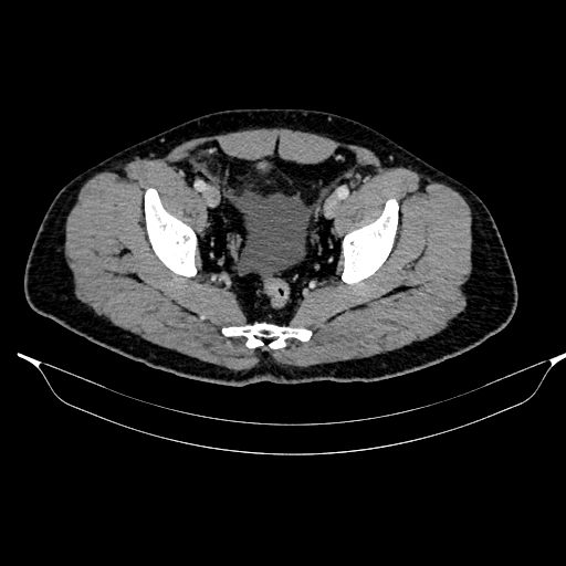 Acute pancreatitis (Radiopaedia 87428-103757 Axial C+ portal venous phase 86).jpg