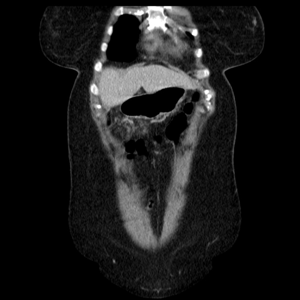 Acute pancreatitis - Balthazar C (Radiopaedia 26569-26714 Coronal C+ portal venous phase 16).jpg