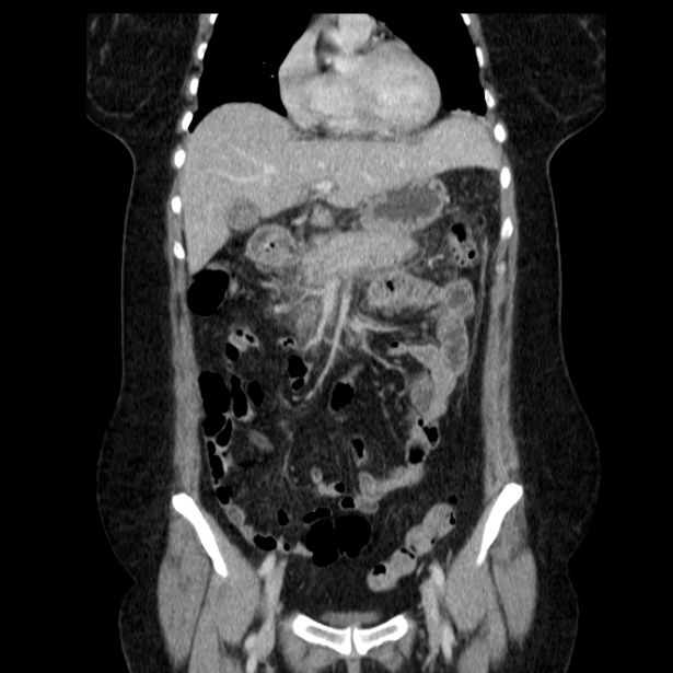 Acute pancreatitis - Balthazar C (Radiopaedia 26569-26714 Coronal C+ portal venous phase 27).jpg