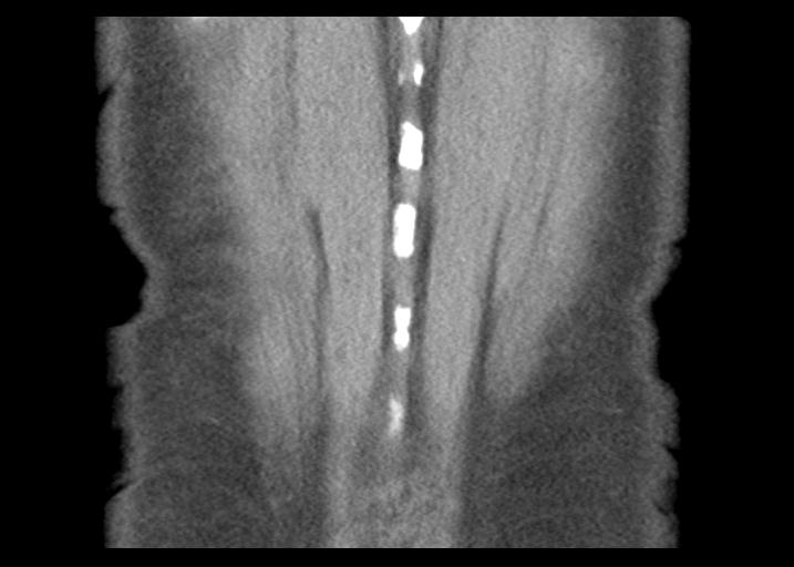 Acute pancreatitis and walled-off necrosis (Radiopaedia 29888-30403 Coronal C+ portal venous phase 53).jpg