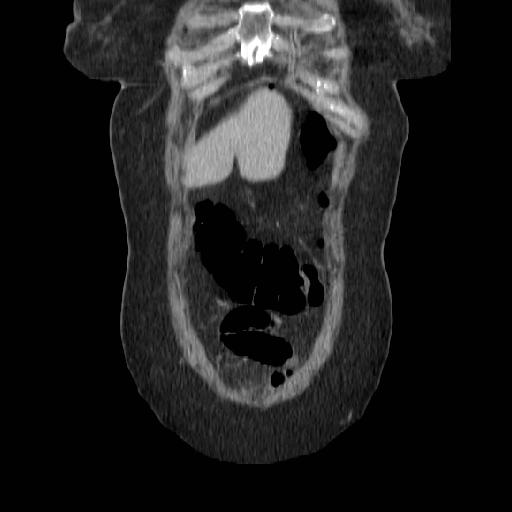 File:Acute perforated diverticulitis (Radiopaedia 14306-14191 Coronal C+ portal venous phase 4).jpg