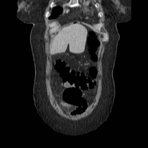 File:Acute perforated diverticulitis (Radiopaedia 14306-14191 Coronal C+ portal venous phase 5).jpg
