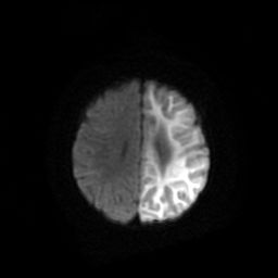 File:Acute phase of hemiconvulsion-hemiplegia epilepsy syndrome (Radiopaedia 29309-29745 Axial DWI 17).jpg