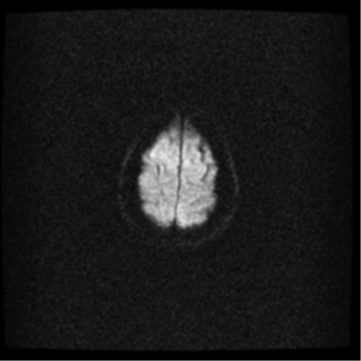 File:Acute pontine infarct from vertebral artery dissection (Radiopaedia 34111-35370 Axial DWI 21).png