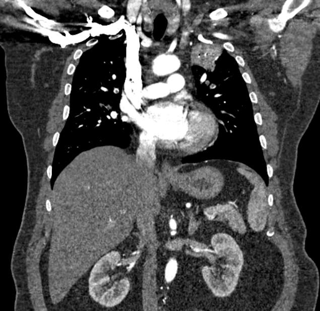 Acute pulmonary embolism with pulmonary infarcts (Radiopaedia 77688-89908 Coronal C+ CTPA 44).jpg