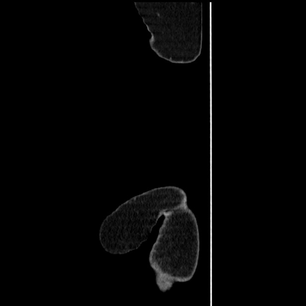 Acute pyelonephritis (Radiopaedia 25657-25837 Sagittal renal parenchymal phase 2).jpg