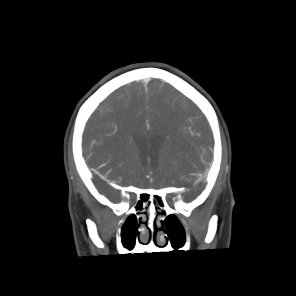 Acute subarachnoid hemorrhage and accessory anterior cerebral artery (Radiopaedia 69231-79009 Coronal C+ arterial phase 30).jpg