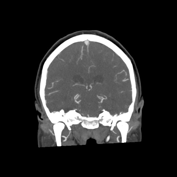 File:Acute subarachnoid hemorrhage and accessory anterior cerebral artery (Radiopaedia 69231-79009 Coronal C+ arterial phase 48).jpg