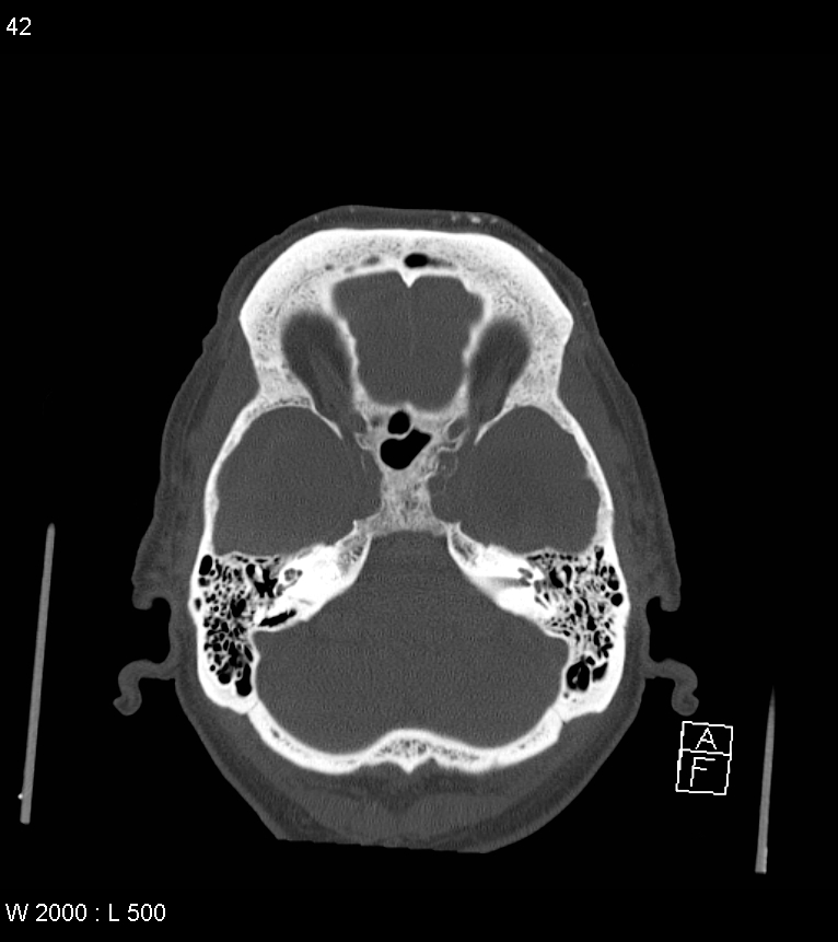 Acute subdural hematoma with myelofibrosis (Radiopaedia 52582-58494 Axial bone window 21).jpg