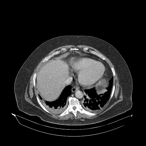 File:Acute superior mesenteric artery occlusion (Radiopaedia 51288-56960 Axial C+ portal venous phase 9).jpg