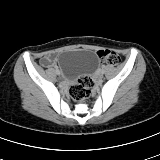 File:Acute suppurative pyelonephritis (Radiopaedia 18306-18147 Axial renal excretory phase 135).jpg