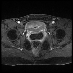 File:Adenocarcinoma arising in a urethral diverticulum (Radiopaedia 12400-12657 Axial T1 C+ fat sat 2).jpg