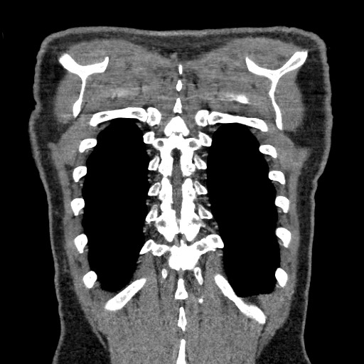 Adenocarcinoma of the lung (Radiopaedia 59871-67325 Coronal C+ arterial phase 66).jpg