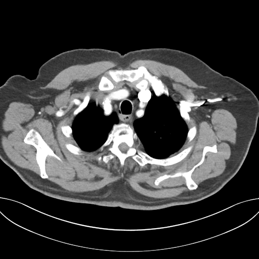 Adenocarcioma of rectum- T1 lesion (Radiopaedia 36921-38547 Axial C+ arterial phase 12).png