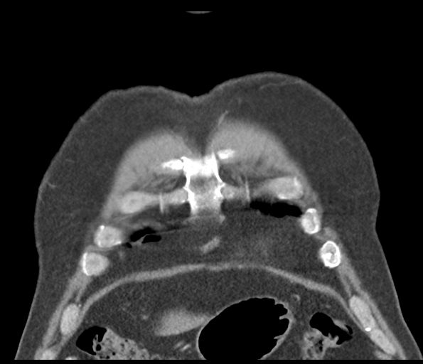 Adenocarcioma of rectum- T1 lesion (Radiopaedia 36921-38547 Coronal C+ arterial phase 12).png