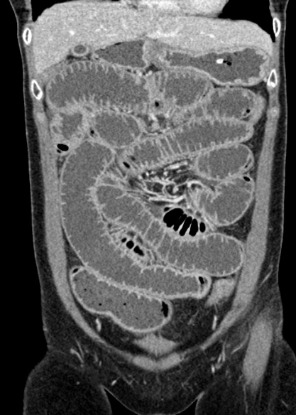 Adhesional small bowel obstruction (Radiopaedia 48397-53305 Coronal C+ portal venous phase 105).jpg
