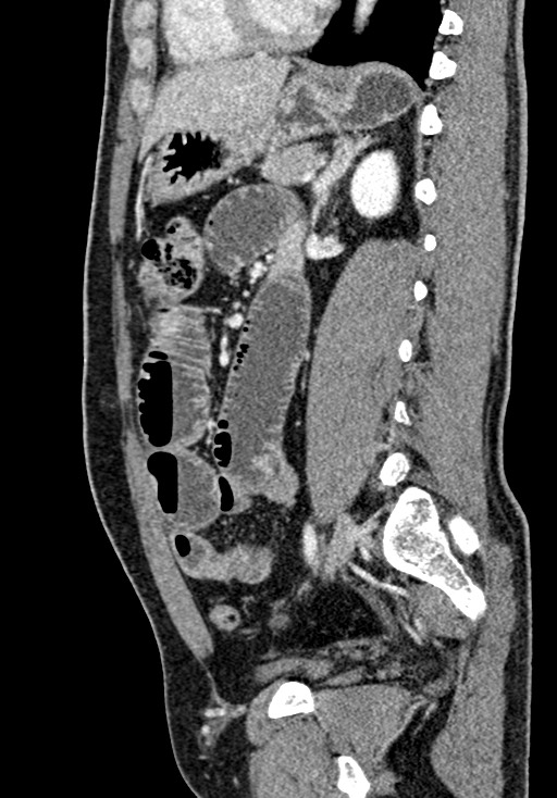 Adhesional small bowel obstruction (Radiopaedia 58900-66131 Sagittal C+ portal venous phase 152).jpg