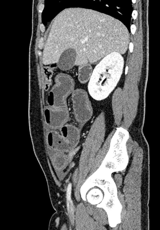 Adhesional small bowel obstruction (Radiopaedia 58900-66131 Sagittal C+ portal venous phase 73).jpg