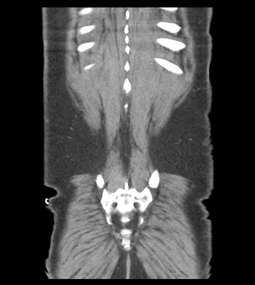 Adhesions within abdominal wall hernia (Radiopaedia 58283-65394 Coronal C+ portal venous phase 62).png