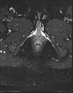 File:Adnexal multilocular cyst (O-RADS US 3- O-RADS MRI 3) (Radiopaedia 87426-103754 Axial T2 fat sat 27).jpg