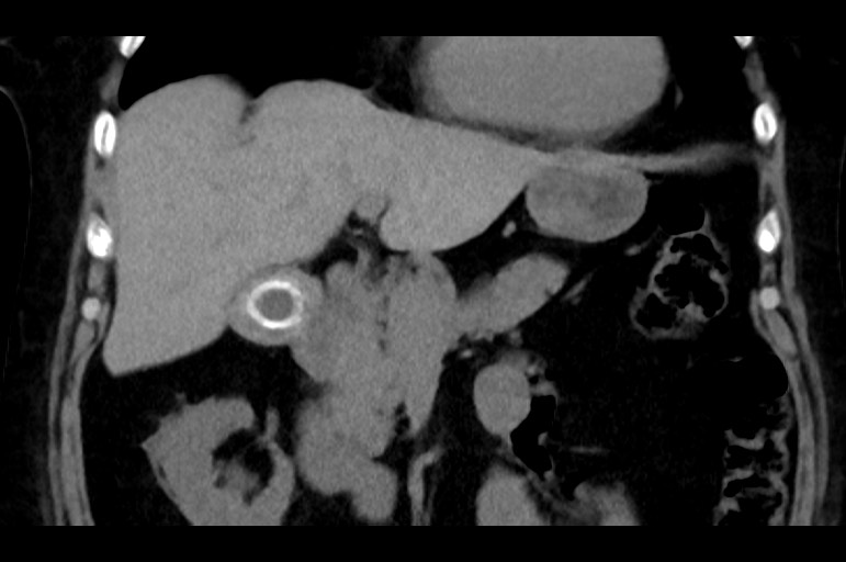 Adrenal cortical carcinoma (Radiopaedia 64017-72769 Coronal non-contrast 22).jpg