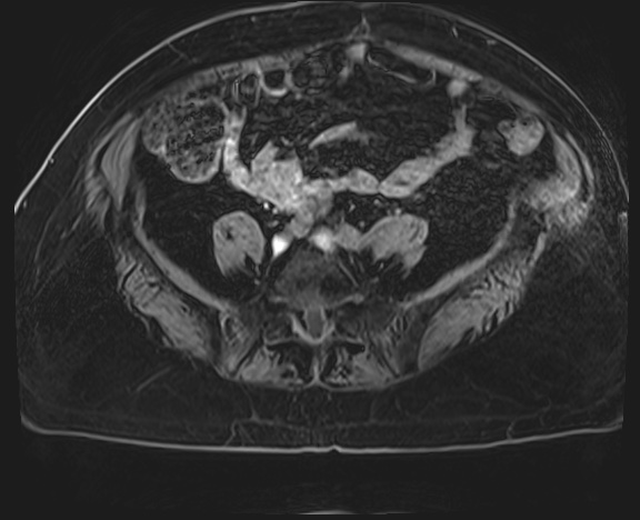 Adrenal cortical carcinoma (Radiopaedia 64017-72770 H 64).jpg