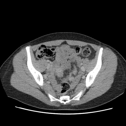 Adrenal cyst (Radiopaedia 64869-73813 Axial C+ portal venous phase 64).jpg
