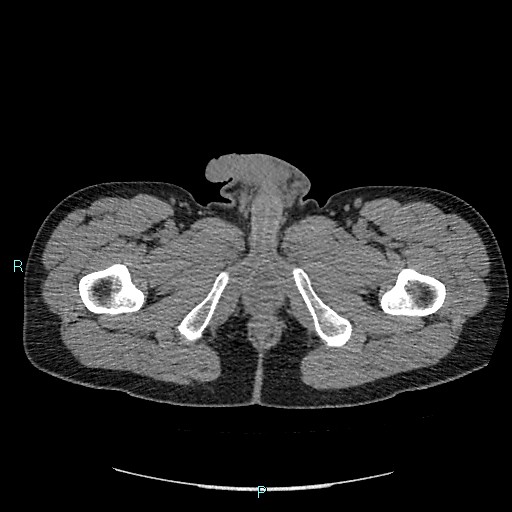 Adrenal cystic lymphangioma (Radiopaedia 83161-97534 Axial non-contrast 110).jpg