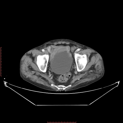 Adrenal hemangioma (Radiopaedia 68923-78668 Axial C+ portal venous phase 63).jpg