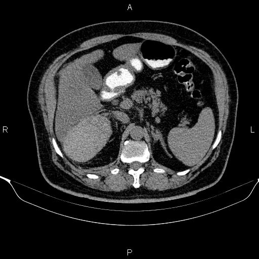 Adrenal hemorrhage (Radiopaedia 62622-70916 Axial non-contrast 59).jpg