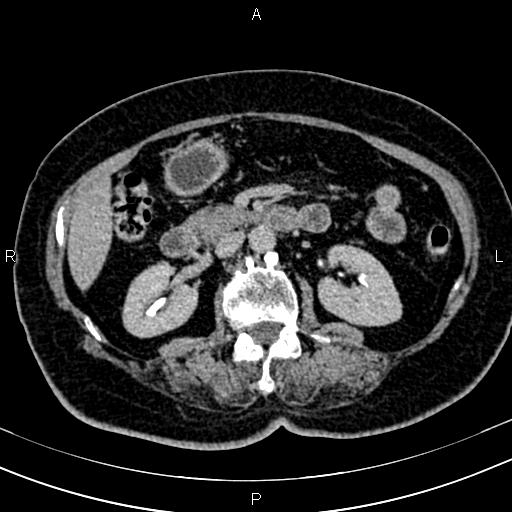 Adrenal myelolipoma (Radiopaedia 82742-96986 Axial renal excretory phase 64).jpg
