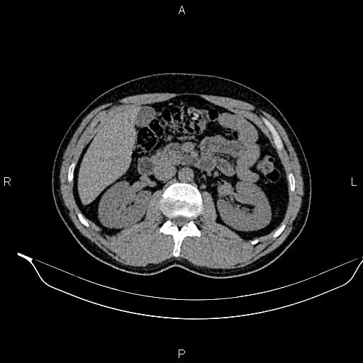 Adrenal myelolipoma (Radiopaedia 87794-104246 Axial non-contrast 43).jpg